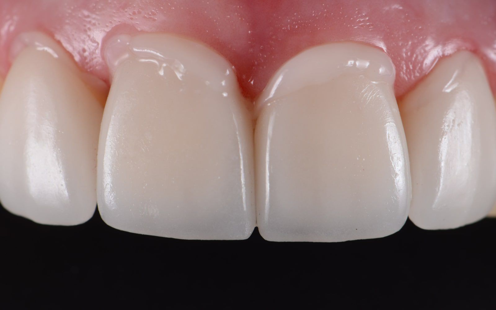 The Different Types of Bonding Material Techniques St Clair Dental