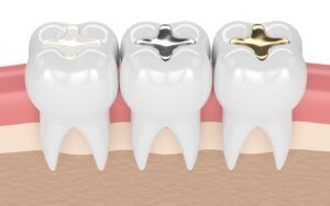 Dental Restoration materials