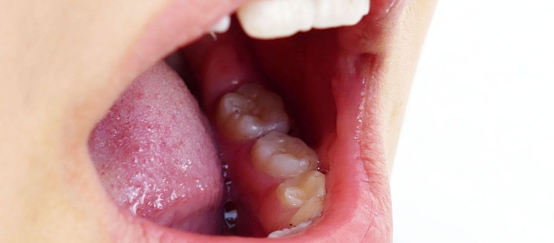 Close Up Photograph of Person's Mouth Showing Teeth and Gums