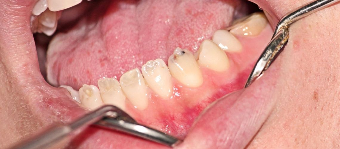 dentinogenesis imperfecta symptoms