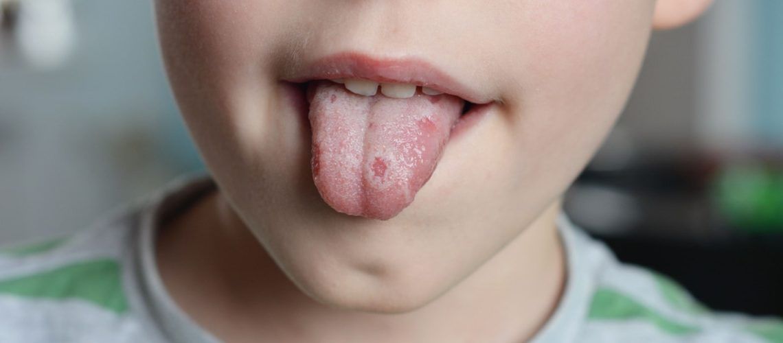 Child with Oral Lichen Planus