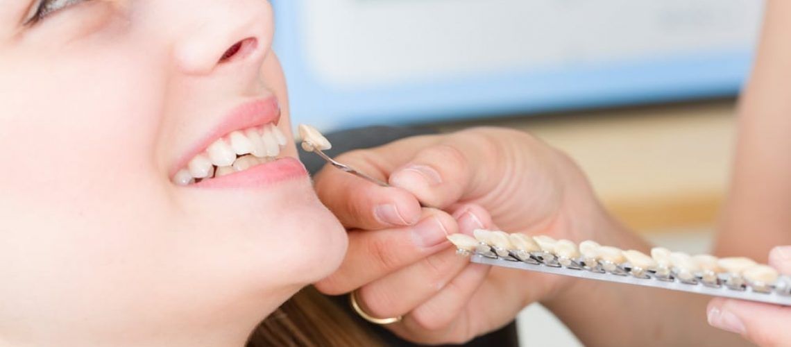 Placement Techniques for Dental Veneers
