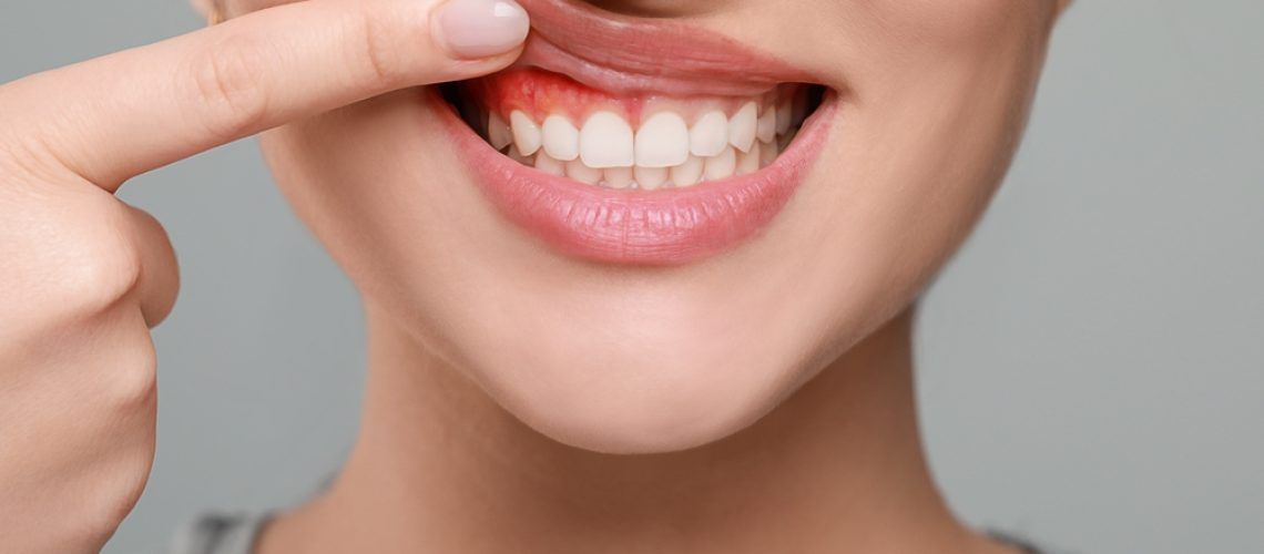 Woman,Showing,Inflamed,Gum,On,Grey,Background,,Closeup